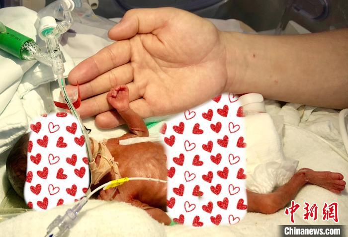 小午出生时体重只有490克,身长仅仅28厘米。 广西妇幼保健院供图 小午出生时体重只有490克,身长仅仅28厘米。 广西妇幼保健院供图