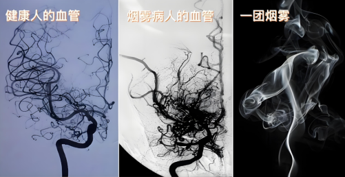 重建大脑血运 大连医科大学附属第二医院为患者打通生命通道